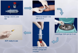 arthrex_acp_double_syringe_system[1]
