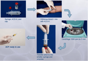 arthrex_acp_double_syringe_system[1]